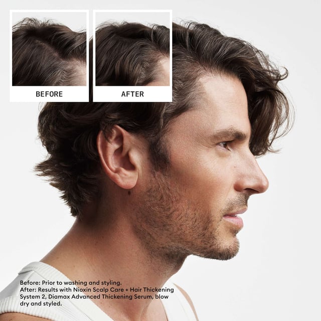 Nioxin Pro Clinical System 2 Trial Kit for Thinning Natural Hair - Complete Hair Care Set Transform your hair with the Nioxin Pro Clinical System 2 Trial Kit, formulated for natural hair experiencing thinning. This kit enhances hair density and thickness, providing visible results in 30 days. It includes:
- Nioxin Pro Clinical Scalp + Hair Shampoo (150ml)
- Nioxin Pro Clinical Scalp + Hair Conditioner (150ml)
- Nioxin Pro Clinical Scalp Care + Hair Thickening Treatment (50ml)
Benefits include a gentle cleansing formula that removes impurities for a healthier scalp and reduces hair breakage. For best results, use at least three times a week.