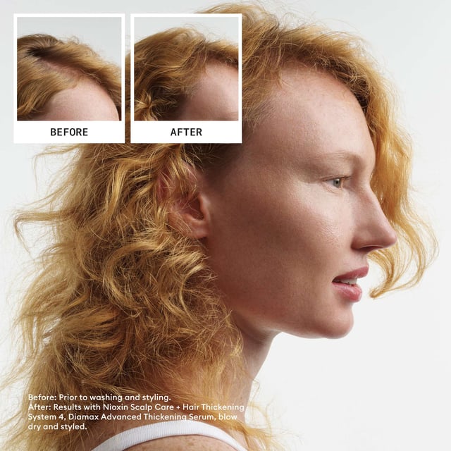 Transform your hair with the Nioxin Pro Clinical System 4 Kit, expertly crafted for dry, damaged, and colour-treated hair showing signs of thinning. This dermatologist-tested kit includes a 300ml Scalp + Hair Shampoo, a 300ml Scalp + Hair Conditioner, and a 100ml Scalp Care + Hair Thickening Treatment. Experience visible results in 30 days, with 8 out of 10 users reporting thicker hair! The advanced formula cleanses the scalp, reducing impurities and excess oil. Infused with nourishing ingredients, this complete system revitalizes your scalp and improves hair health.