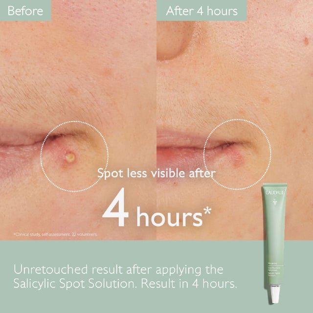 Discover the ultimate solution for blemishes with Caudalie Vinopure Salicylic Acid Spot Treatment. This fast-acting remedy harnesses natural salicylic acid, niacinamide, and tea tree oil to calm irritation and reduce redness. Its unique formula targets spots directly, offering a refreshing botanical scent in an eco-friendly aluminium tube. For best results, apply directly to blemishes and let dry as a mask or leave on overnight for treatment. Join Caudalie's mission to plant trees; they have planted over 8 million trees by 2021.